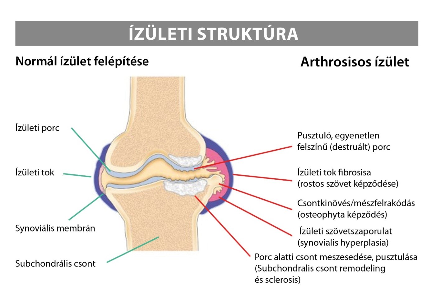 artrozis minden ízületben fájdalommentes térd deformáció